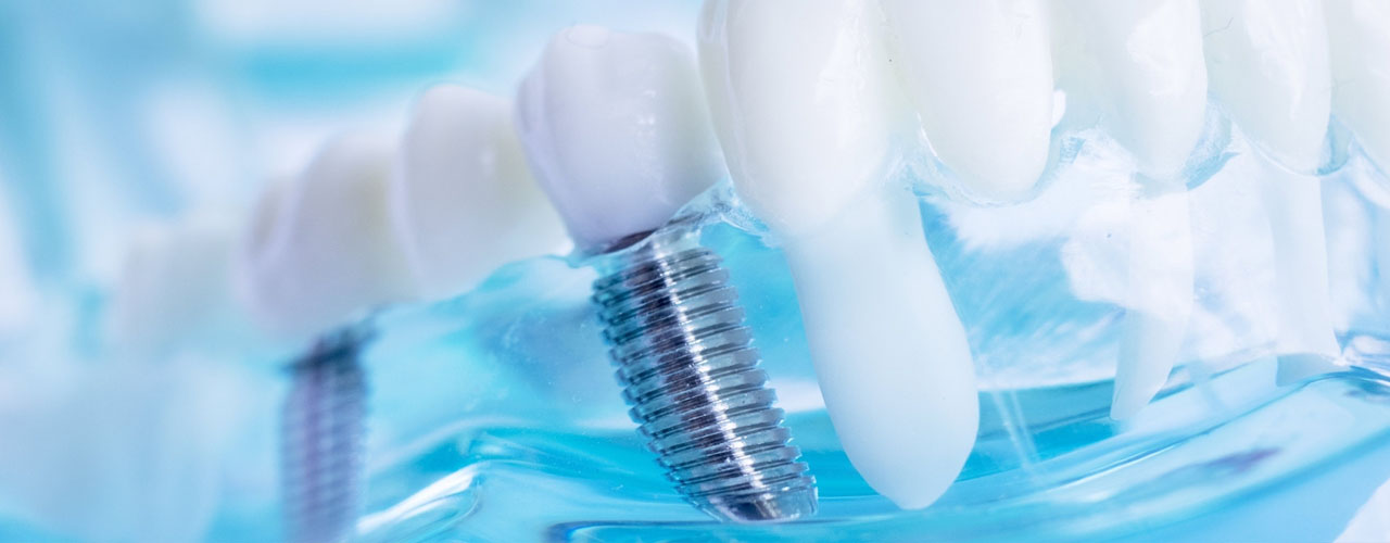 implants dentaires à Laval
